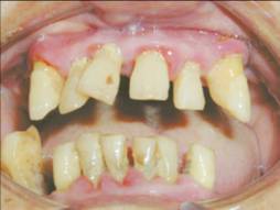 重度歯周病の歯肉